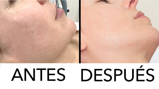 El método más efectivo para eliminar Marcas de Acné y reducir Poros con Láser